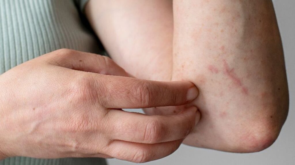 Gatal Lebih dari Sekadar Sensasi Menggaruk