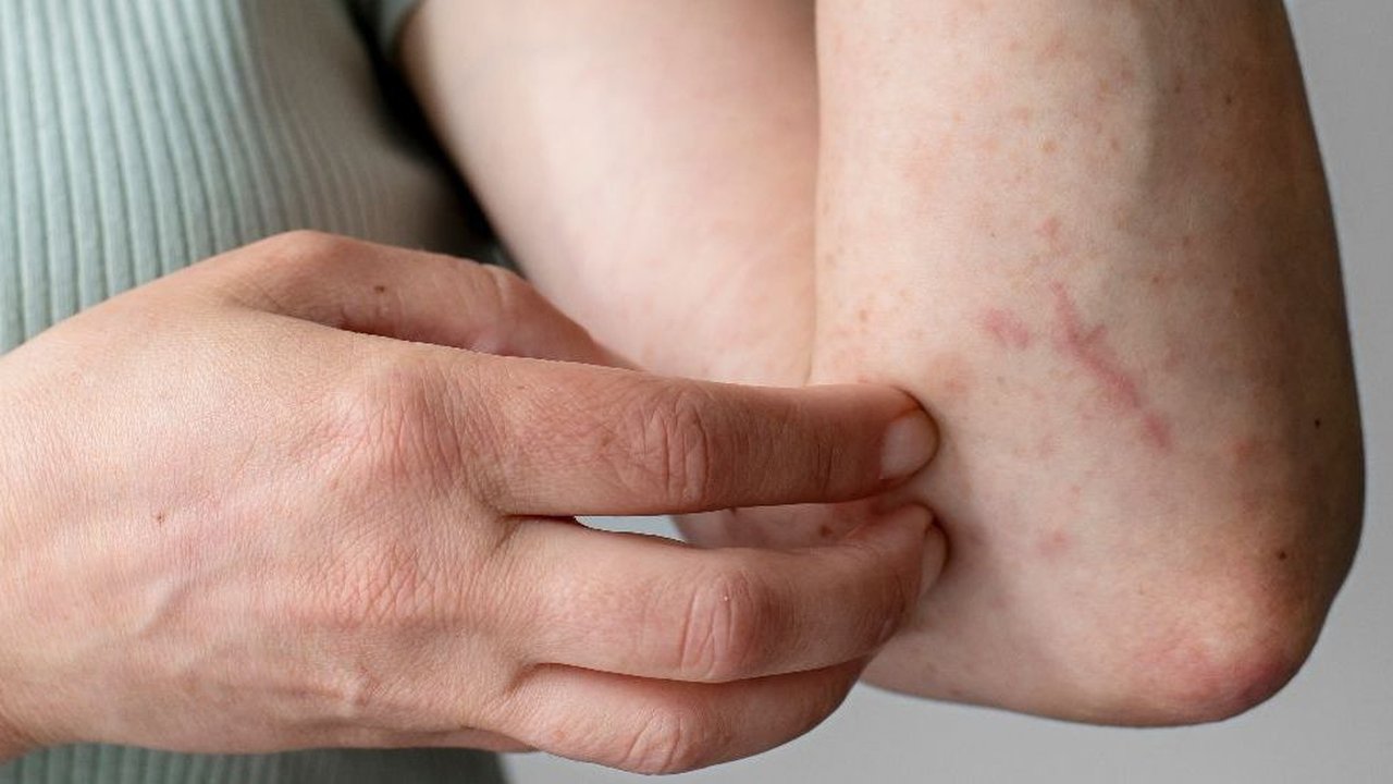 Gatal Lebih dari Sekadar Sensasi Menggaruk