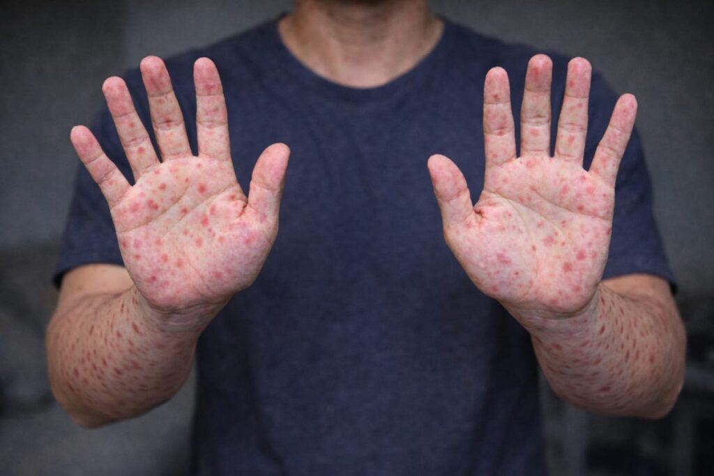 Campak Terdeteksi Pada Penumpang Transit Singapura